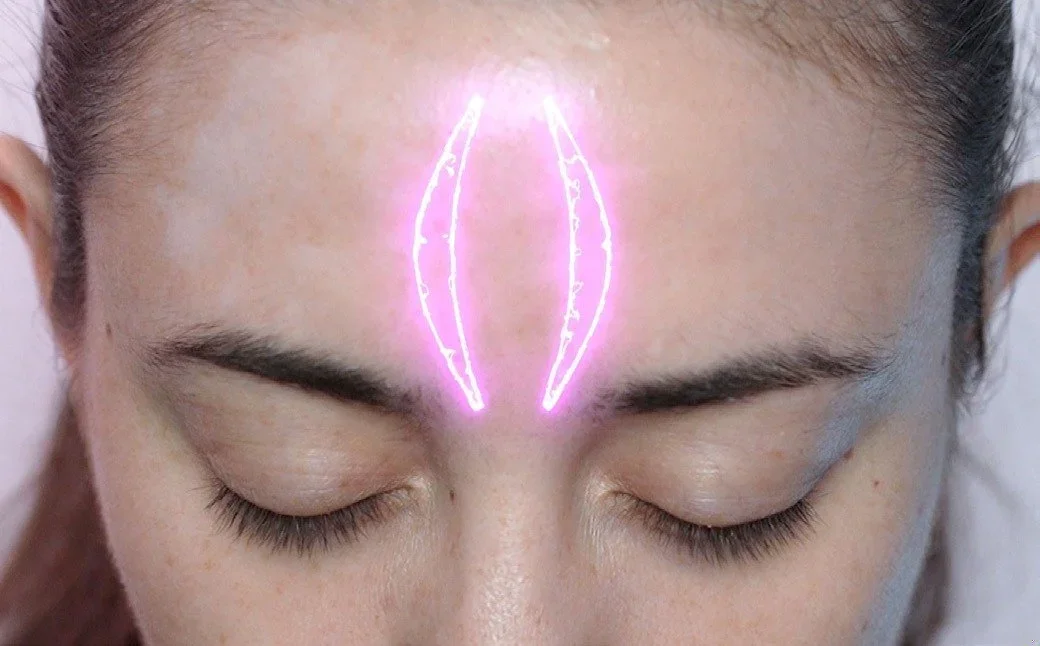 FOREHEADVULVA